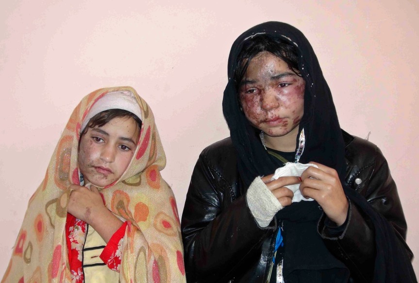 Members of a family receive treatment at a hospital after being attacked with acid at their home by unknown gunmen in Kunduz